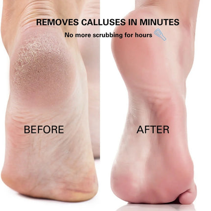 Rechargeable Callus Remover